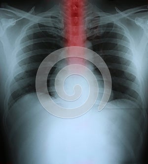 Xray of a human thorax with esophagus highlighted in red