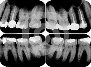 Xray image of capped tooth photo