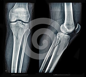 Xray images showing real fracture of leg bone under the knee after injury