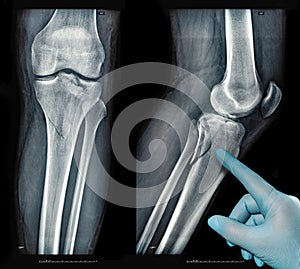 Xray images showing real fracture of leg bone under the knee after injury