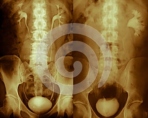 Xray of the kidneys