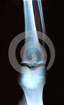 Xray of a Knee - front view
