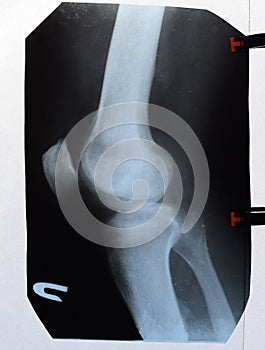 Xray of the knee joints, a picture of the bones of the knee on the x-ray