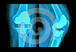 Xray knee prosthesis