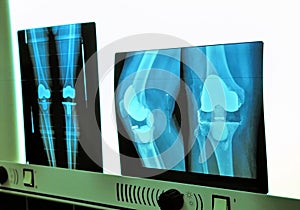 Xray knee prosthesis
