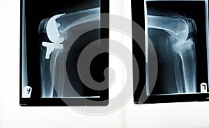 A xray of a knee replacement