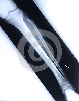 Xray/leg