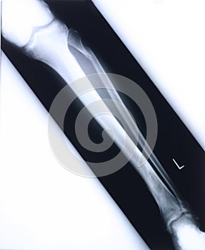 Xray/leg