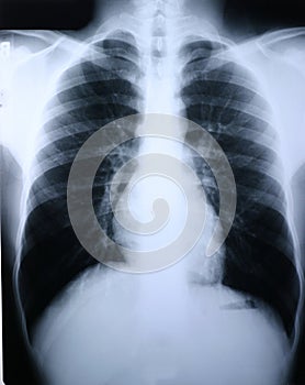 Xray/lung