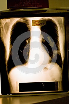 Xray of lung cancer