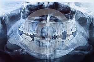 Xray of mouth