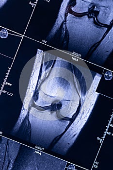 Xray MRI examination magnetic resonance images showing real knee blue tone