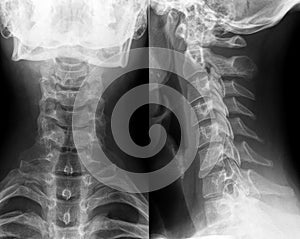 Xray of neck and cervical spine photo