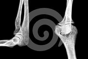 Xray pathology human elbow