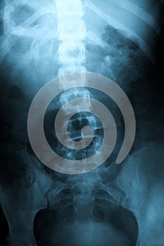 Xray of Pelvic Bones, Vertebra, Ribs