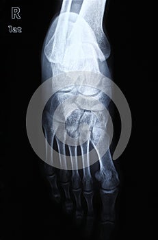 Xray picture