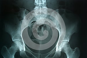 Xray picture pelvis