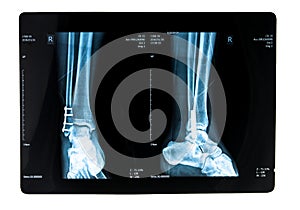 Xray picture