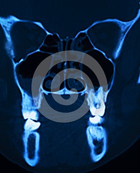 Xray scan skull nose