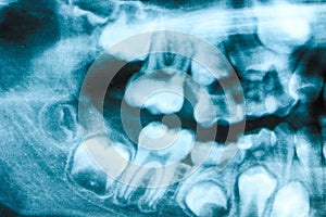 Xray scan of teeth