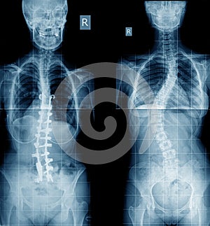 Xray of scoliosis human photo