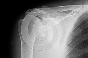 Plain film X-ray of shoulder - radiography, normal