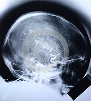 Xray/skull 1