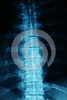 Xray spine