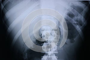 Xray/spine 3 photo