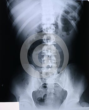 Xray/spine