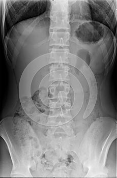 Xray Spine and Pelvis of a Human Body