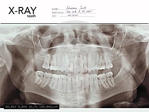 Xray teeth mouth dental tomography. Vector X-ray radiology oral panorama. Medical skeleton x ray background.