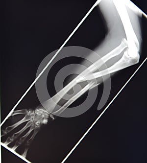 Xray upper extremity fracture monteggia