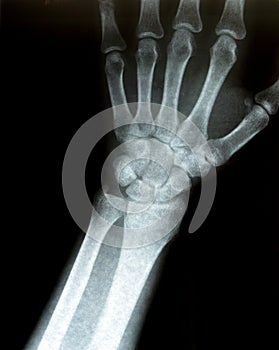 Xray of a wrist