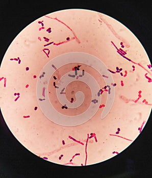 yeast cells and hyphae in gram stain fine with microscope.