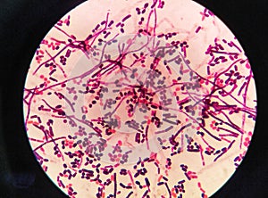 yeast cells and hyphae in gram stain fine with microscope.