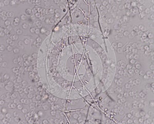 Yeast cells in urine sample.