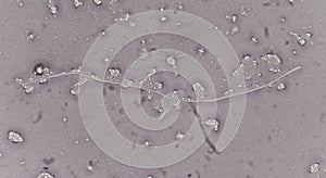 Yeast cells in urine specimens.