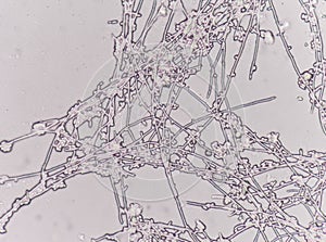 Yeast cells in urine specimens.