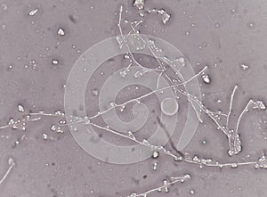 Yeast cells in urine specimens.