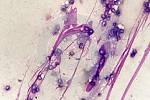 Yeast form of Talaromyces marneffei in skin of AIDS patient