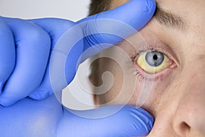 De masculino ojo. síntoma de ictericia inflamación del hígado o problemas bilis vejiga tracto hígado 