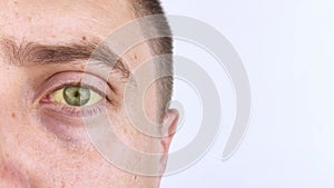 The yellow color of the man eye. Symptom of jaundice, hepatitis or problems with the gall bladder, gastrointestinal tract, liver.