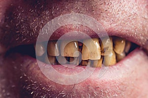 Yellow and curved teeth of a smoker covered with dental stone