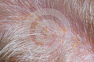 Yellow dandruff scales on the hair. Seborrhea