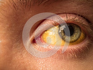 Yellow staining of the sclera of the eye in diseases of the liver, cirrhosis, hepatitis