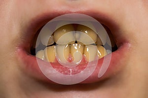 Yellow teeth with caries