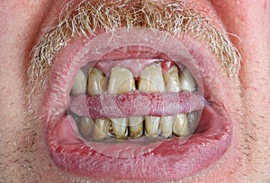 Yellow teeth and mustache, bitten tongue and dry lips in an elderly old man macro