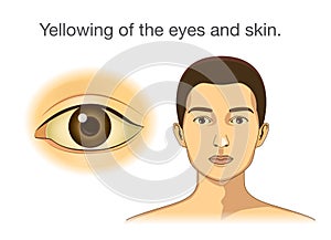 Yellowing of the eyes and skin.