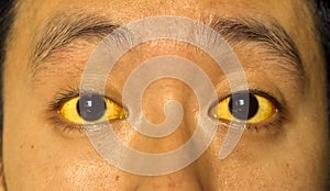 Yellowish discoloration of skin and sclera or deep jaundice in face of Southeast Asian young man.